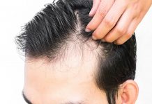 Caspa o descamación: cómo diferenciarlas y tratarlas correctamente
