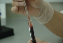 La sangre en la orina, el síntoma principal del cáncer de vejiga