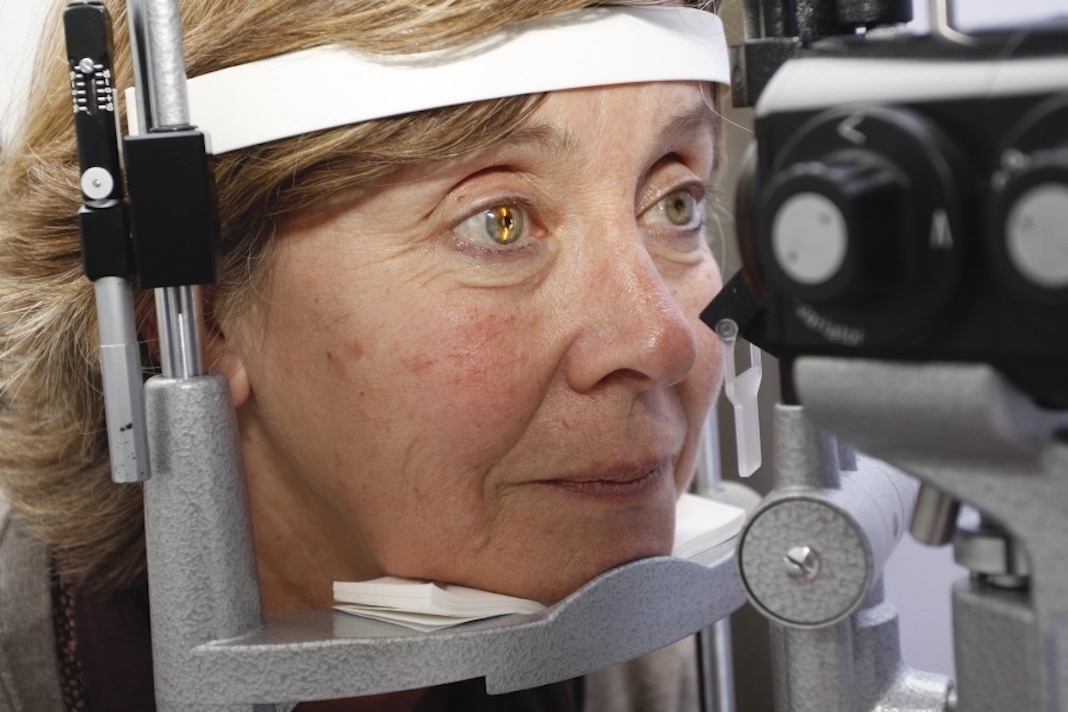 REVISIÓN DE DEGENERACIÓN MACULAR
