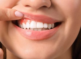 Si estás pensando en mejorar tu sonrisa con carillas, ten en cuenta estos consejos