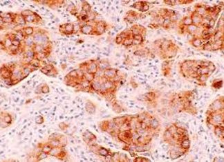 Descubren la causa de la reaparición del tumor linfático y su resistencia terapéutica