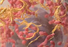 El adenocarcinoma uno de los subtipos de cáncer de pulmón más frecuentes: este es el abordaje habitual