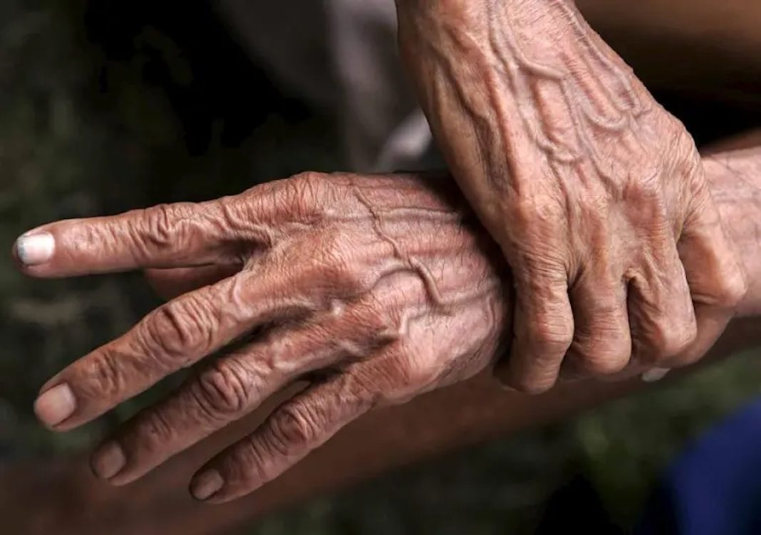 Vejez Osteoporosis