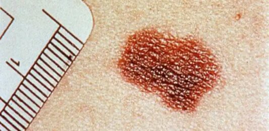 Melanoma, claves de un cáncer con una vacuna en el horizonte