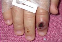 Guía sobre mpox: síntomas, transmisión y tratamiento